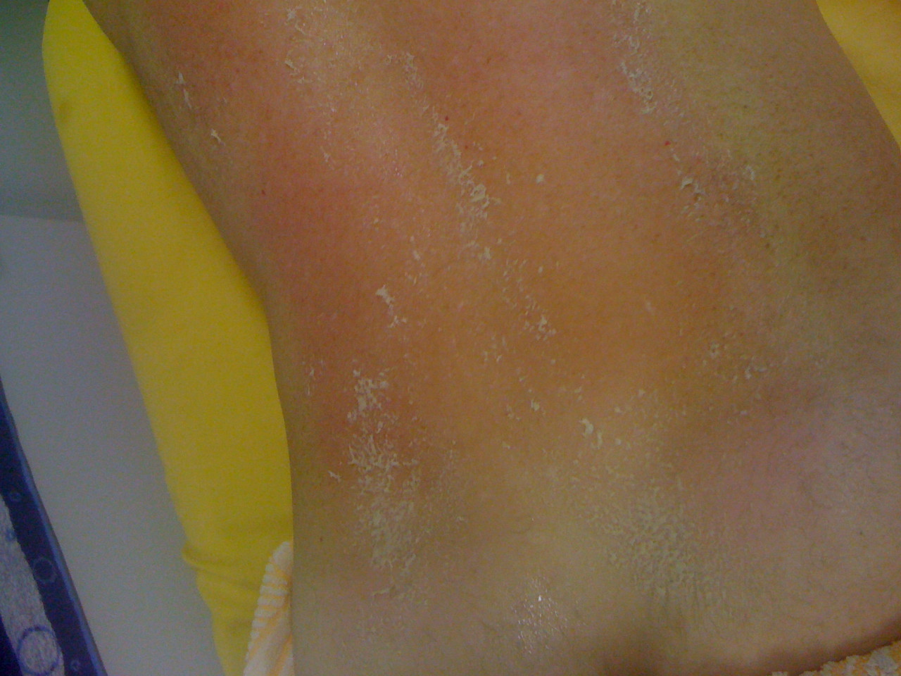 Medová masáž - záda